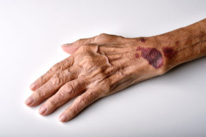 Spotting Nursing Home Abuse Near You