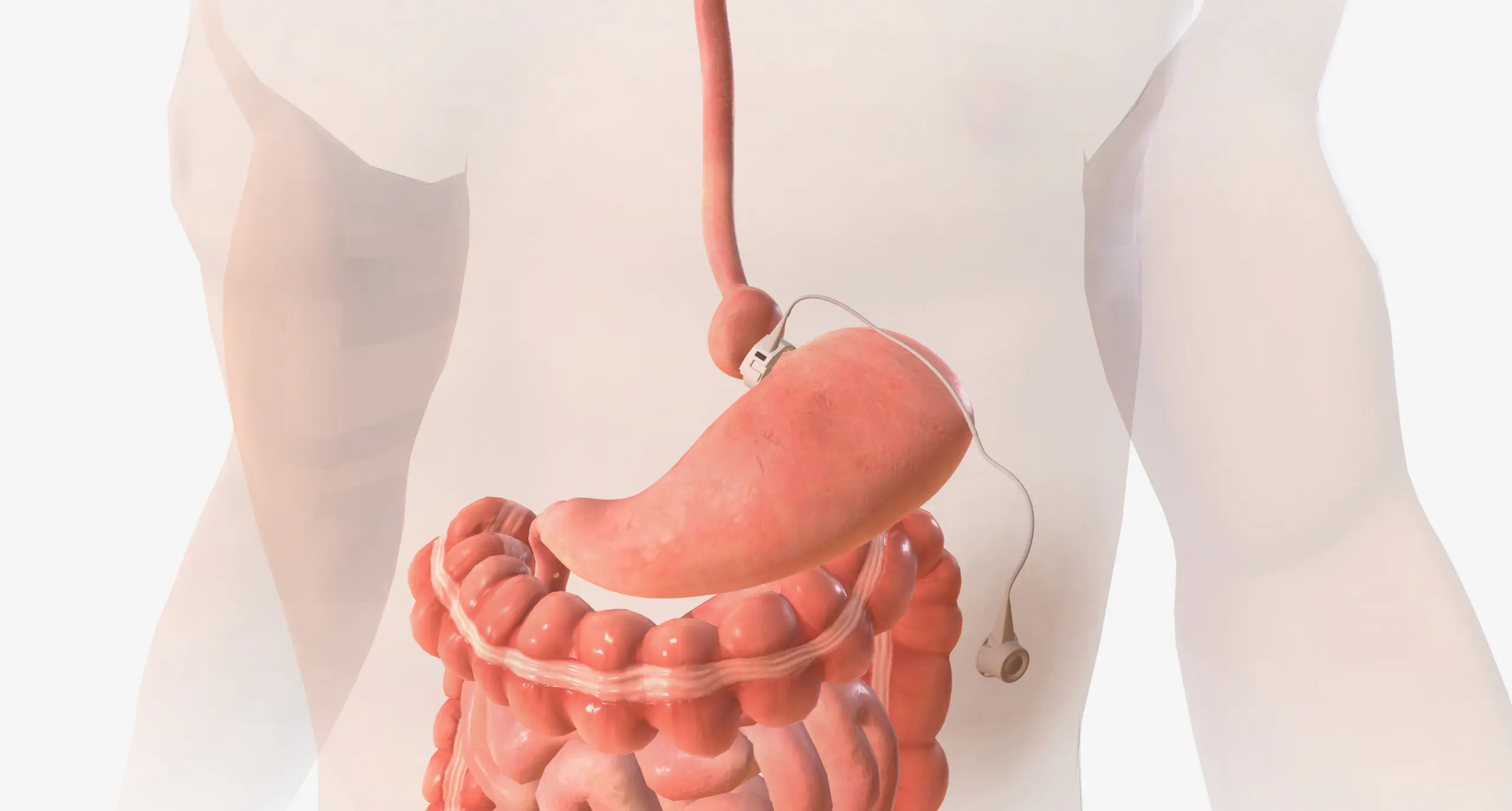 allergan lap band lawsuits